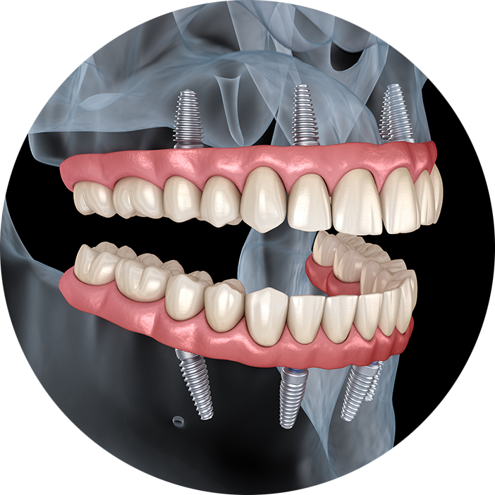 Full Arch Dental Implants