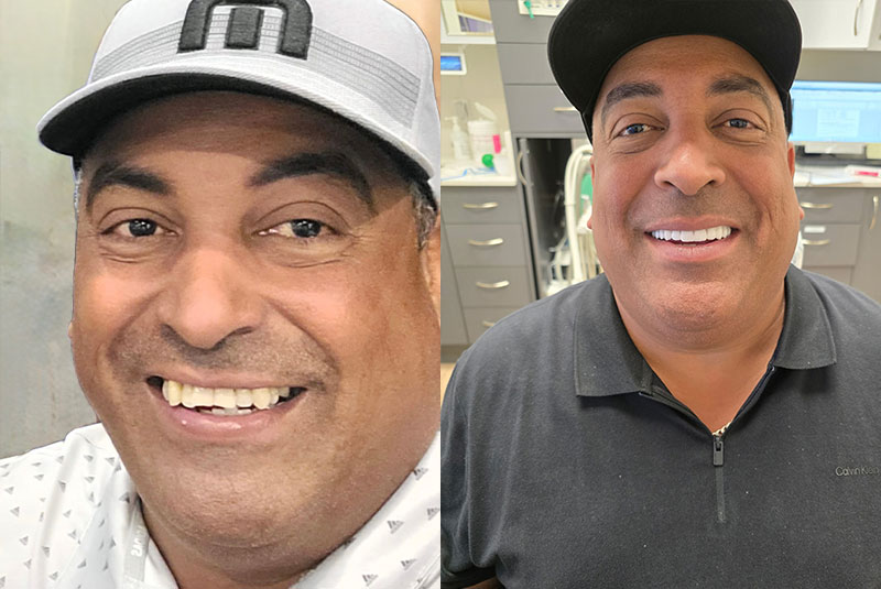 all on x before after