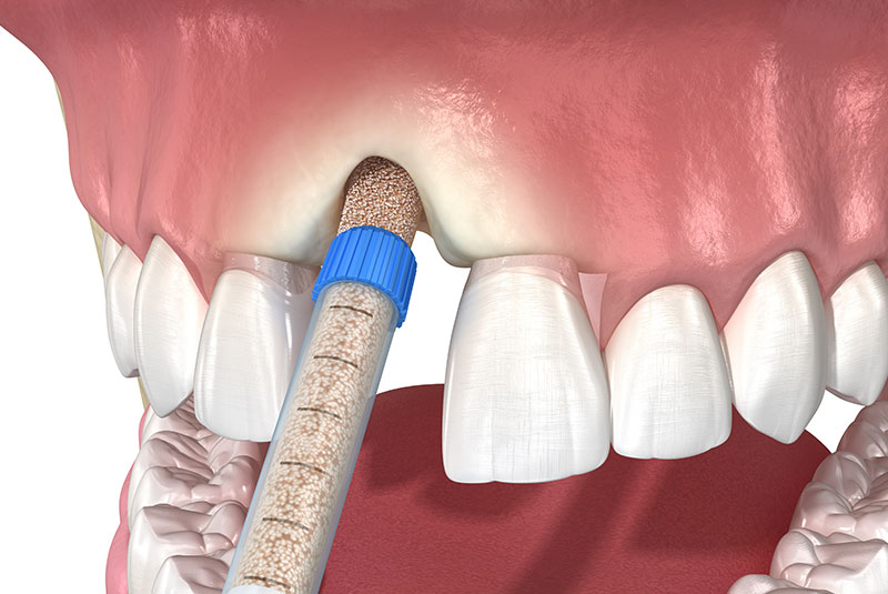 bone grafting