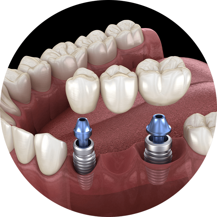dental bridge circle