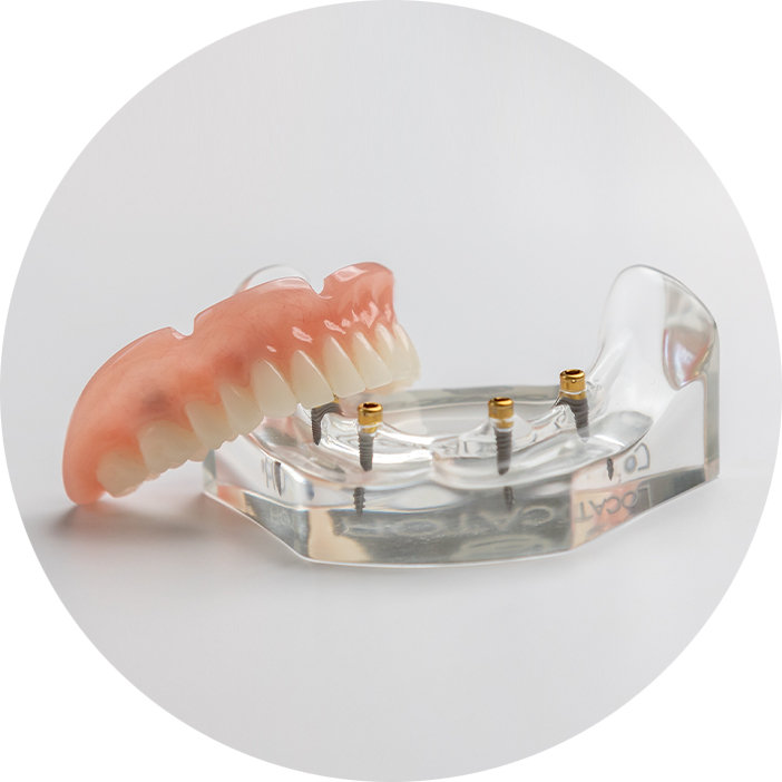 Implant-Supported Dentures