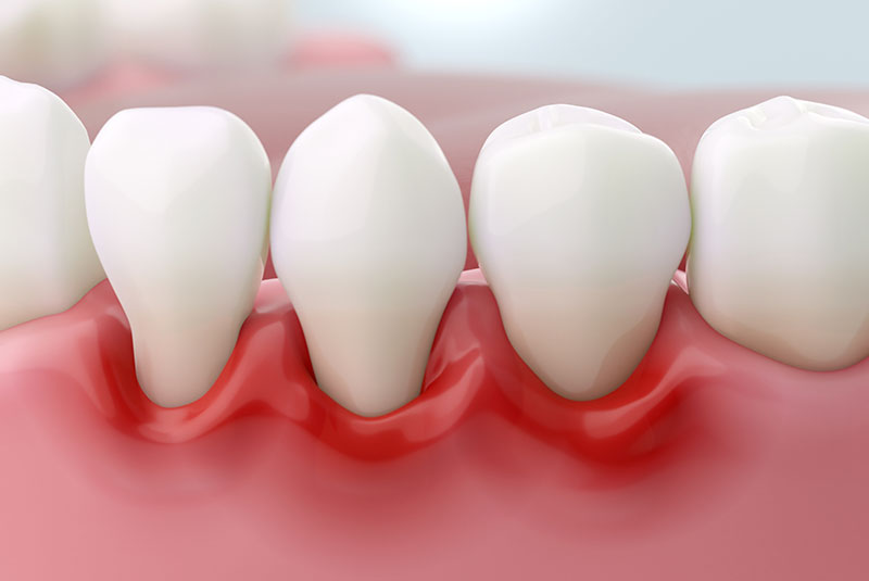 gum disease 5050