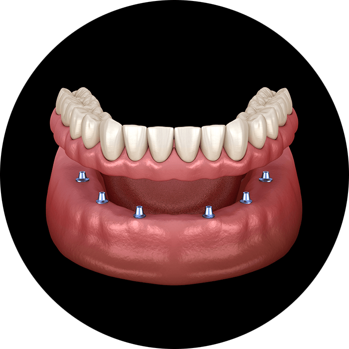implant denture circle