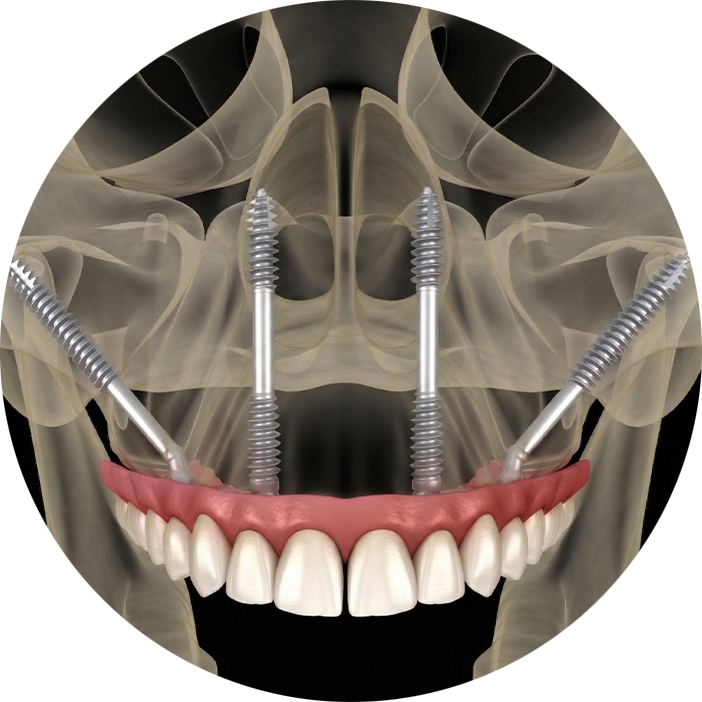 Transnasal Implants