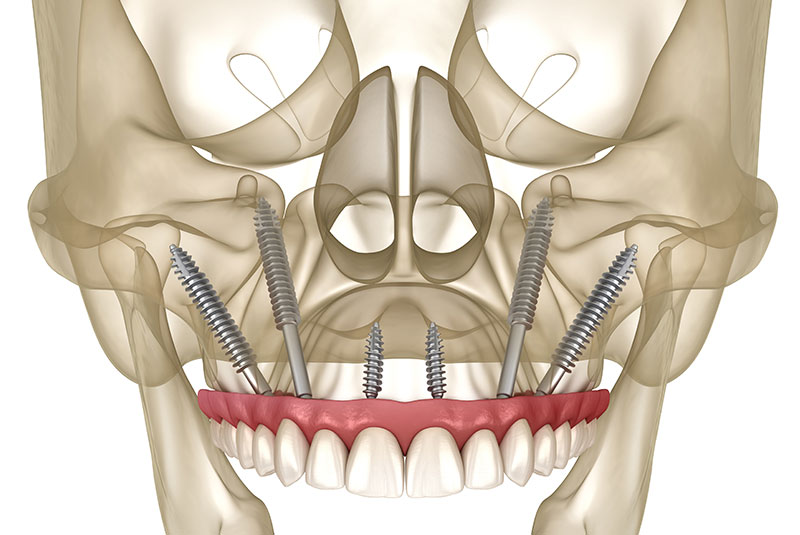 pterygoid implants