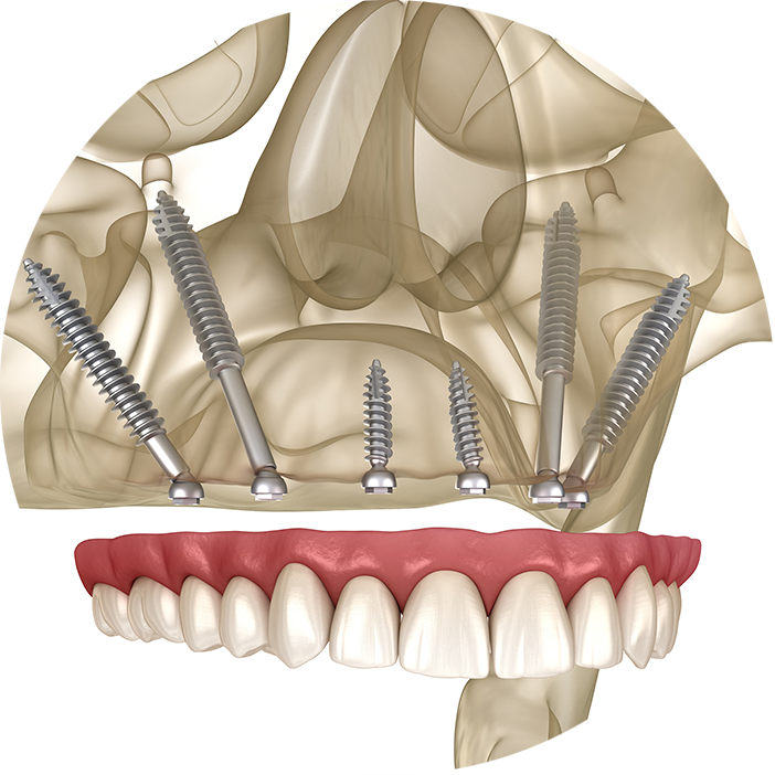 Pterygoid Implants