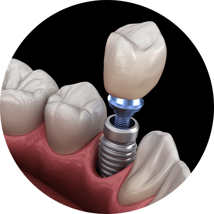single implant circle