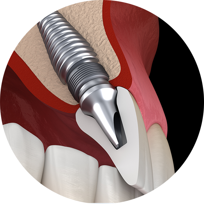 Single Dental Implants