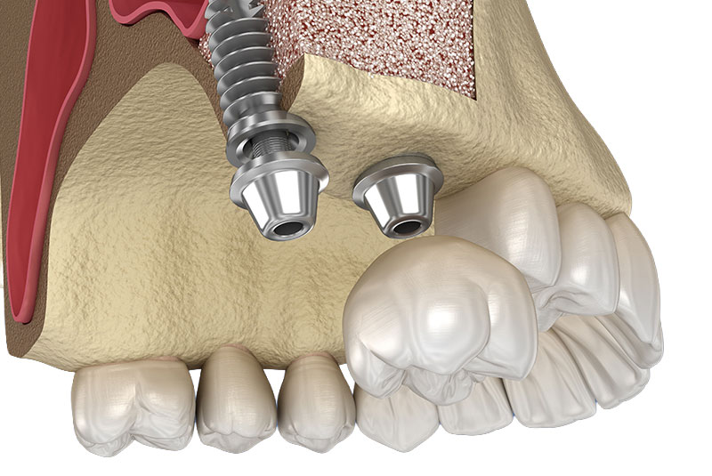 sinus implant