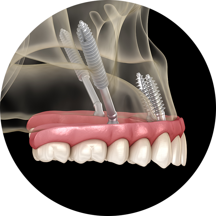 Zygomatic Implants