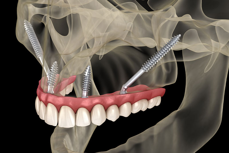 zygomatic 5050