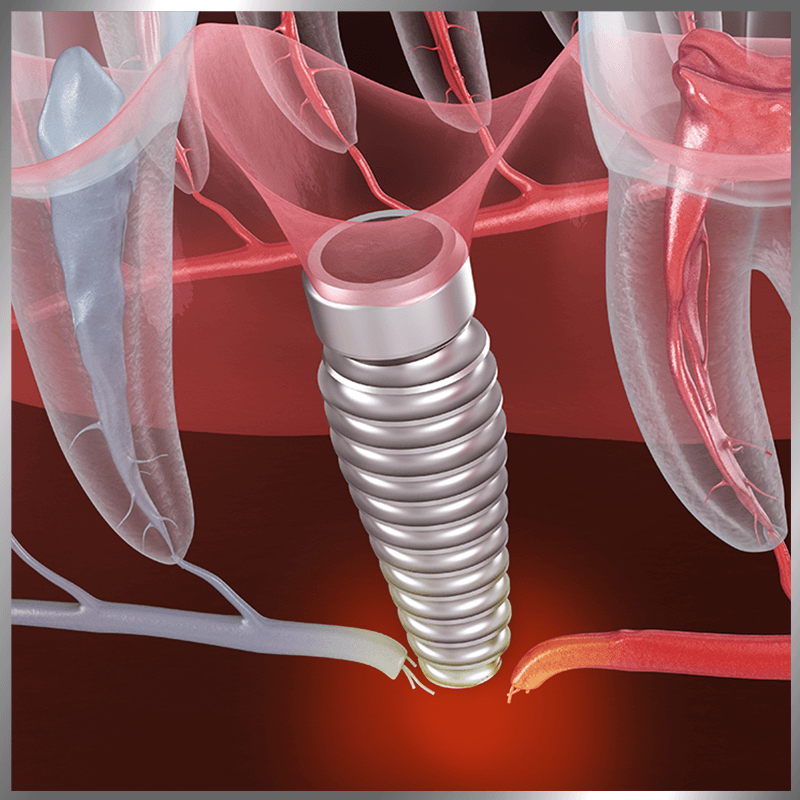implant failure